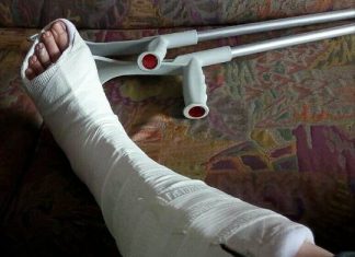 Füße ertragen viel Gipsfuss-stebo